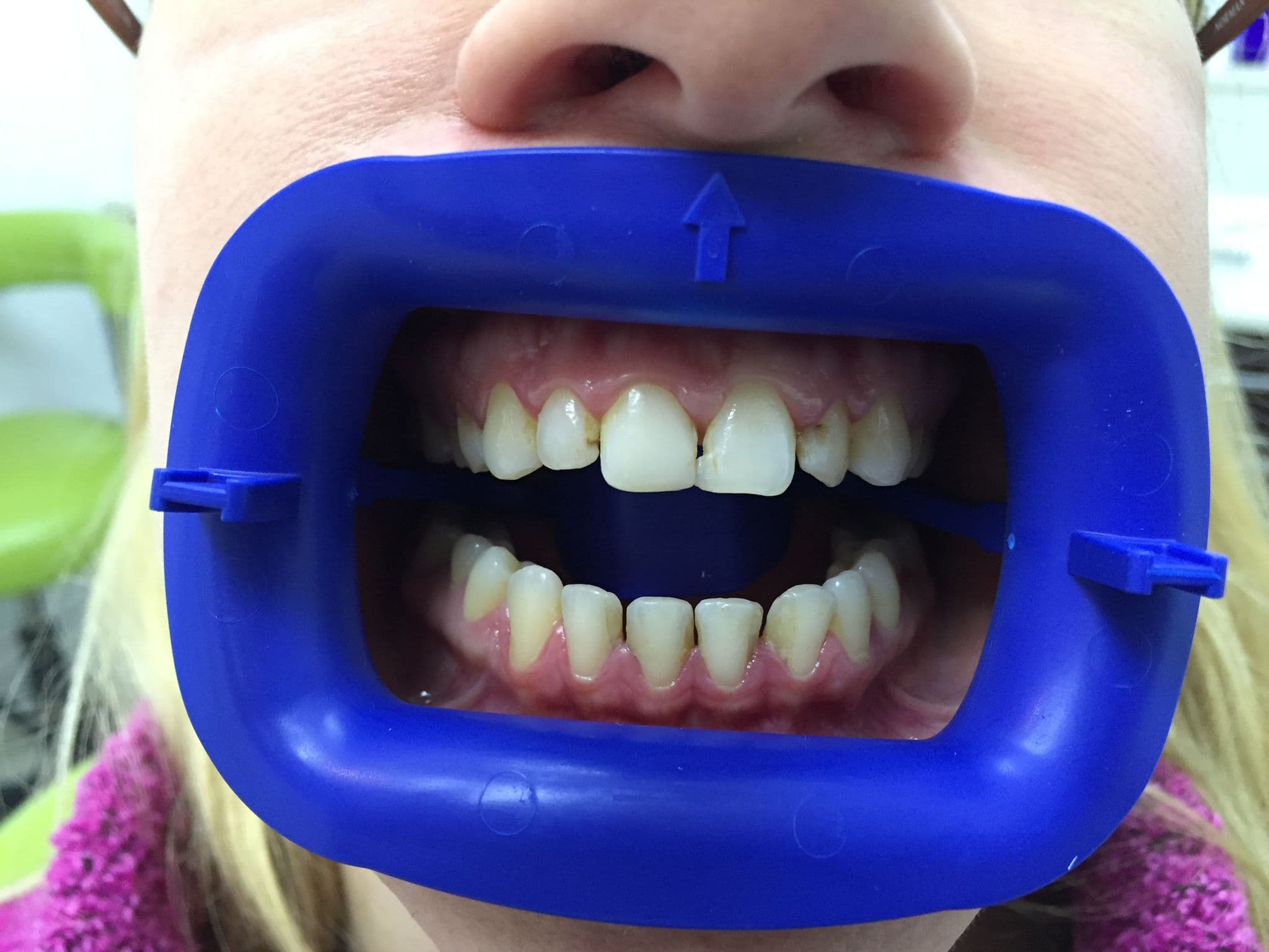Full Smile Transformation — before
