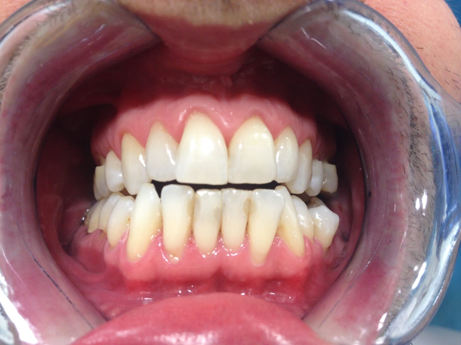 Professional teeth whitening results at Dental Clinic London
