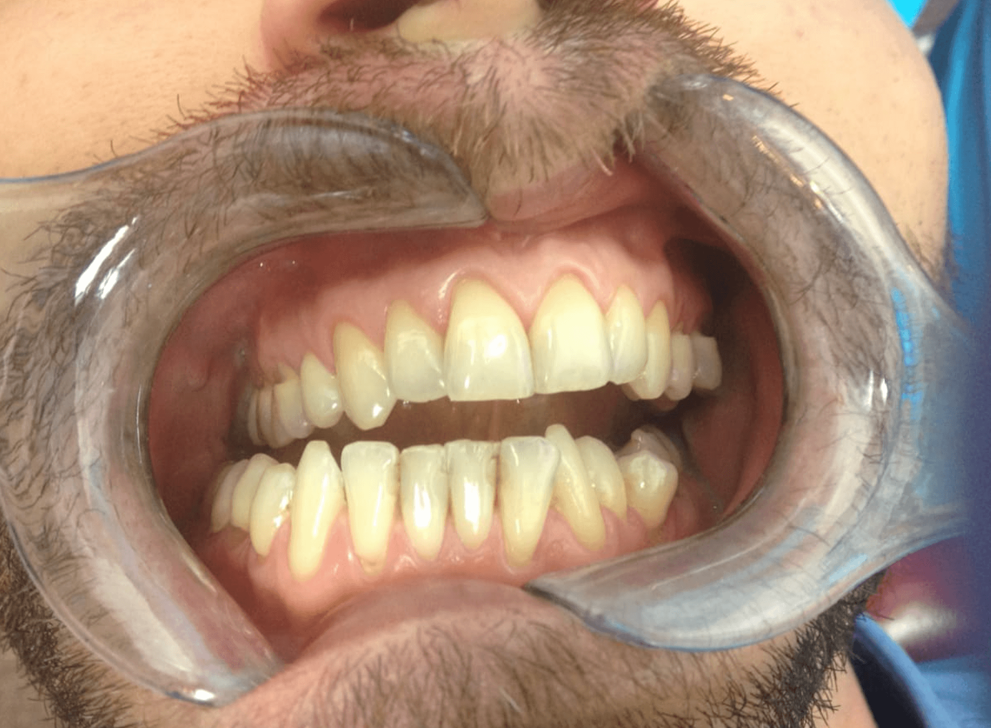 Home Teeth Whitening — before