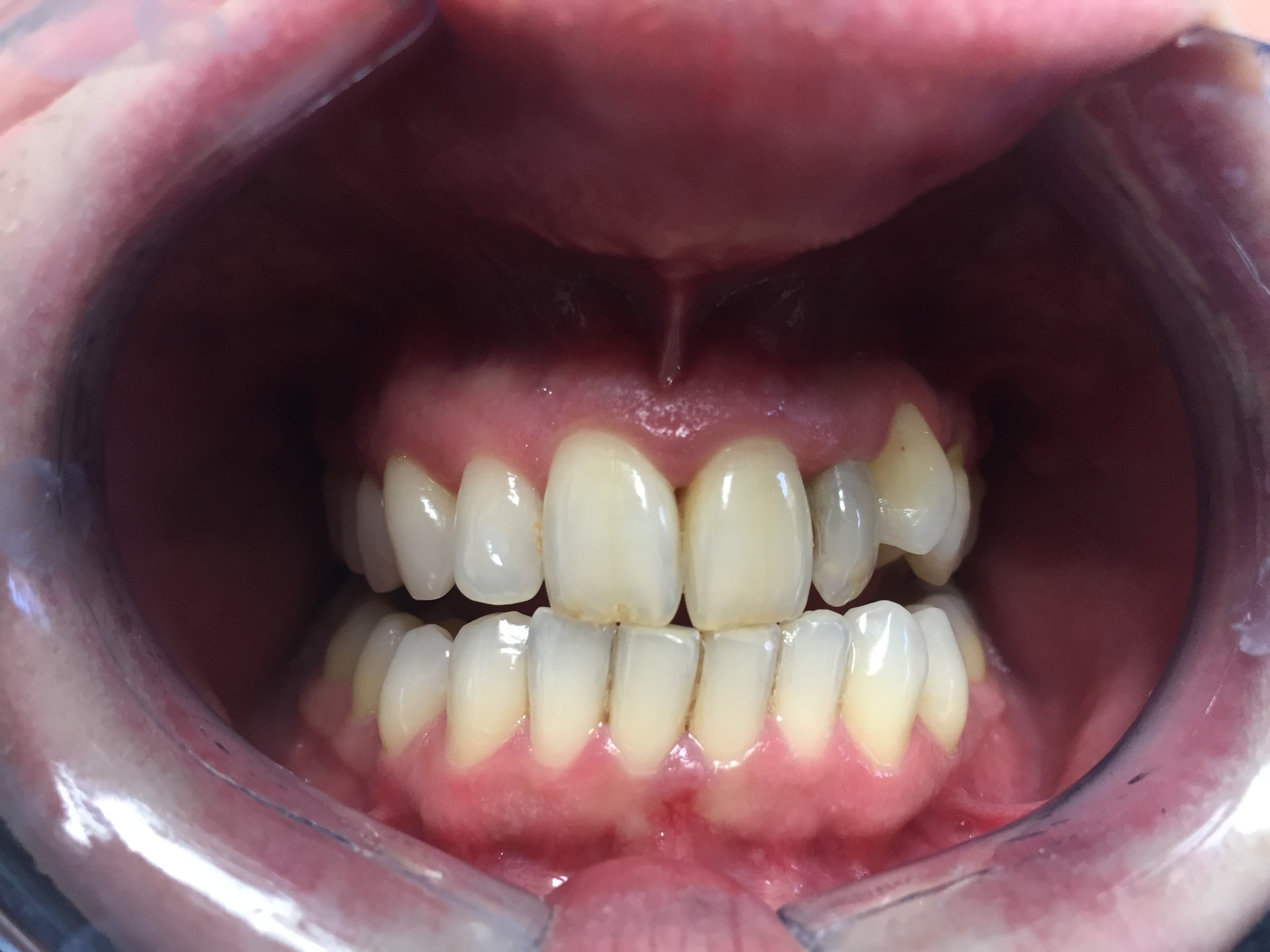 In-Surgery Teeth Whitening — before
