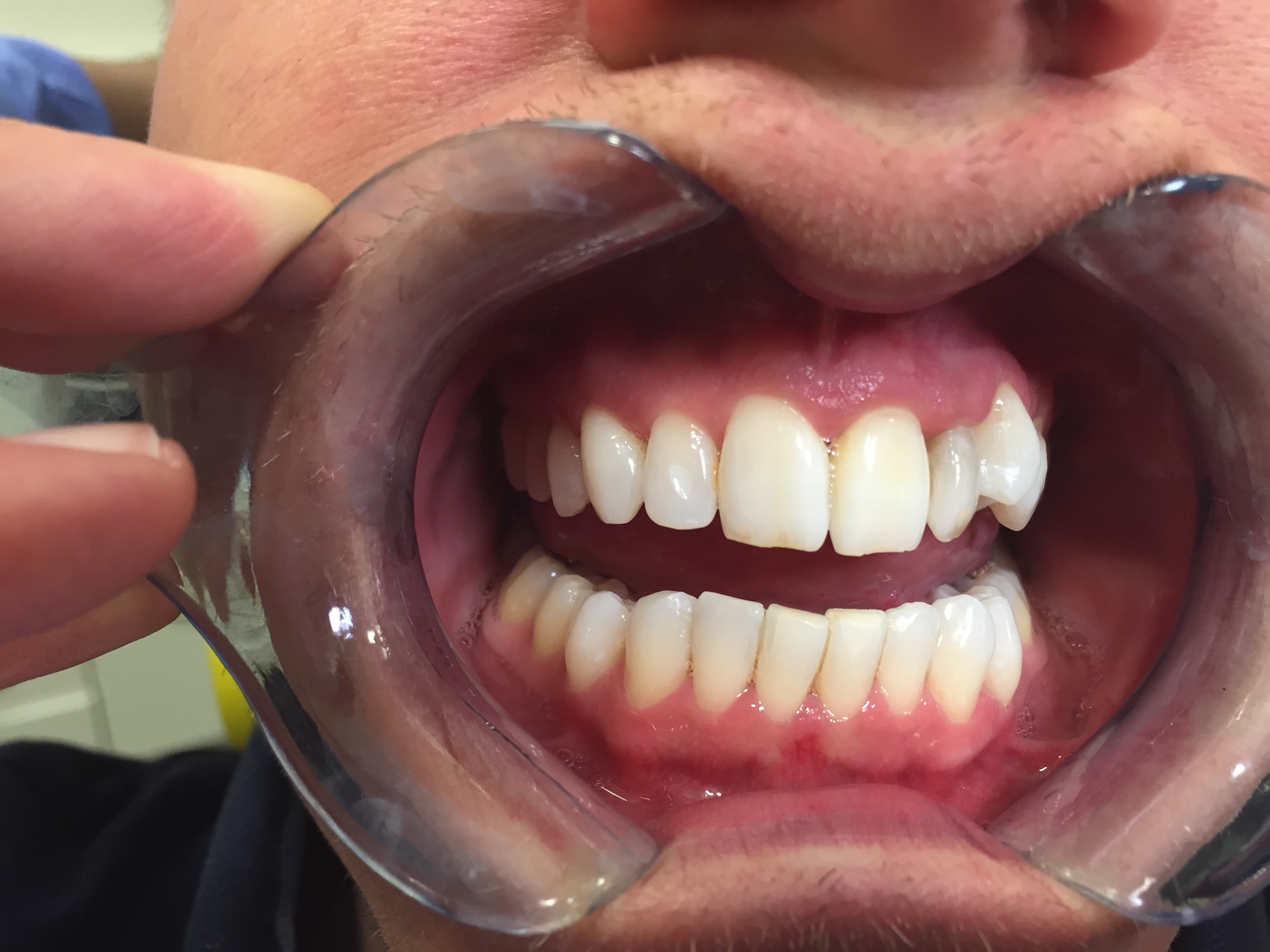 In-Surgery Teeth Whitening — after