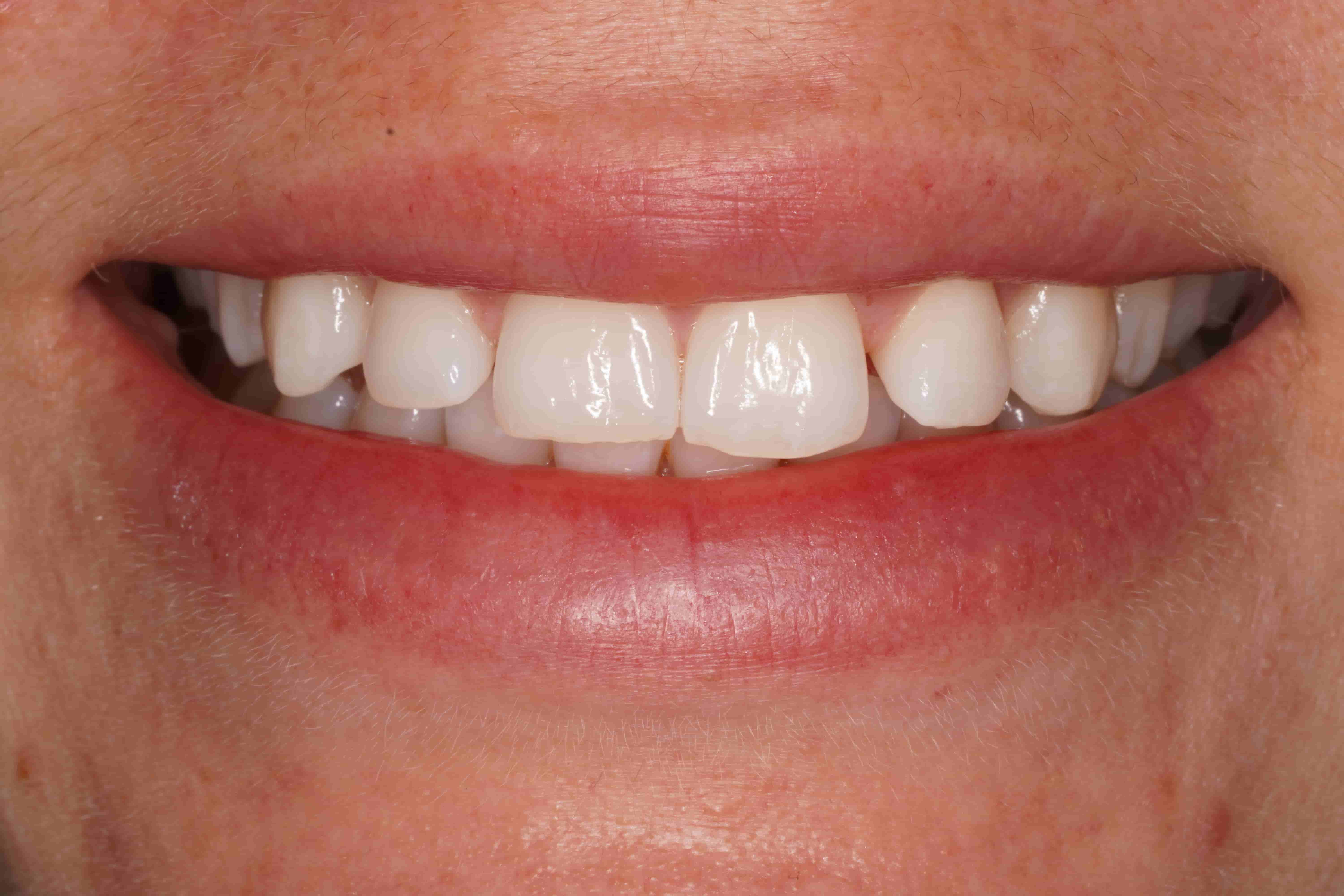 Professional Teeth Whitening — after