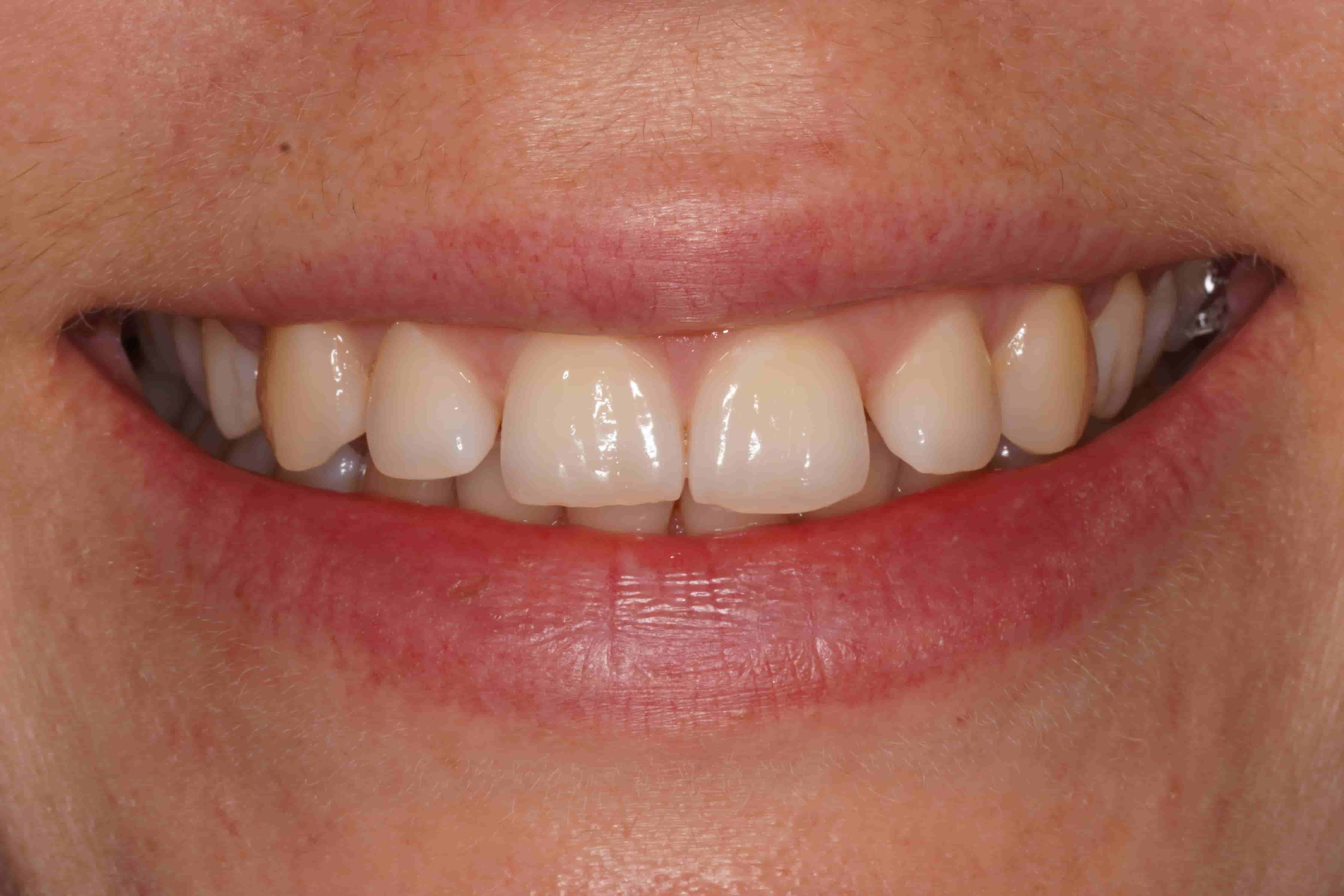 Professional Teeth Whitening — before
