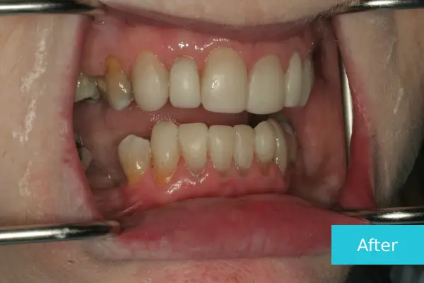 Invisalign after 
