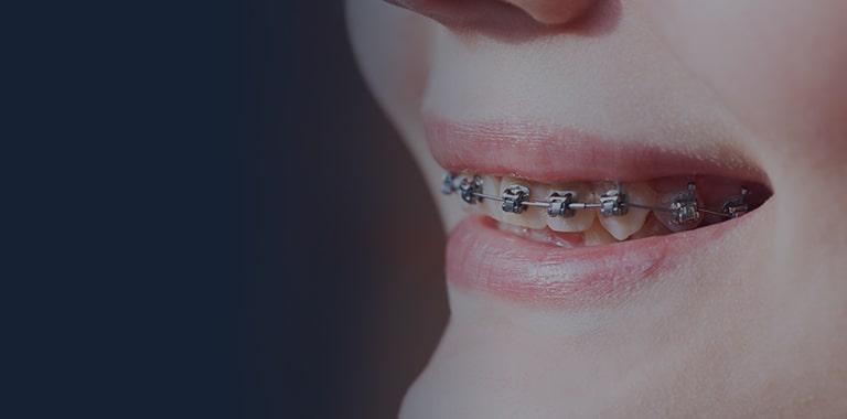 Damon Braces London – adult braces offers - Dental Clinic London